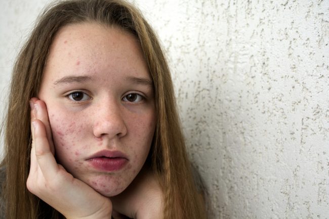 menina adolescente com rosto cheio de espinhas